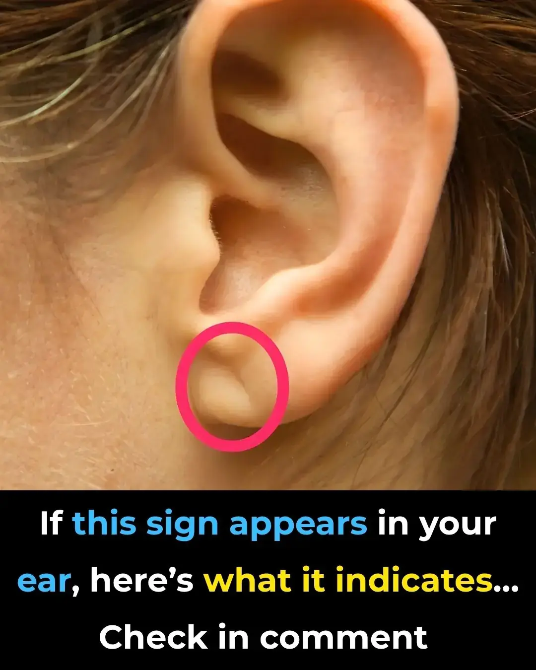 ¿Qué es el signo de Frank?