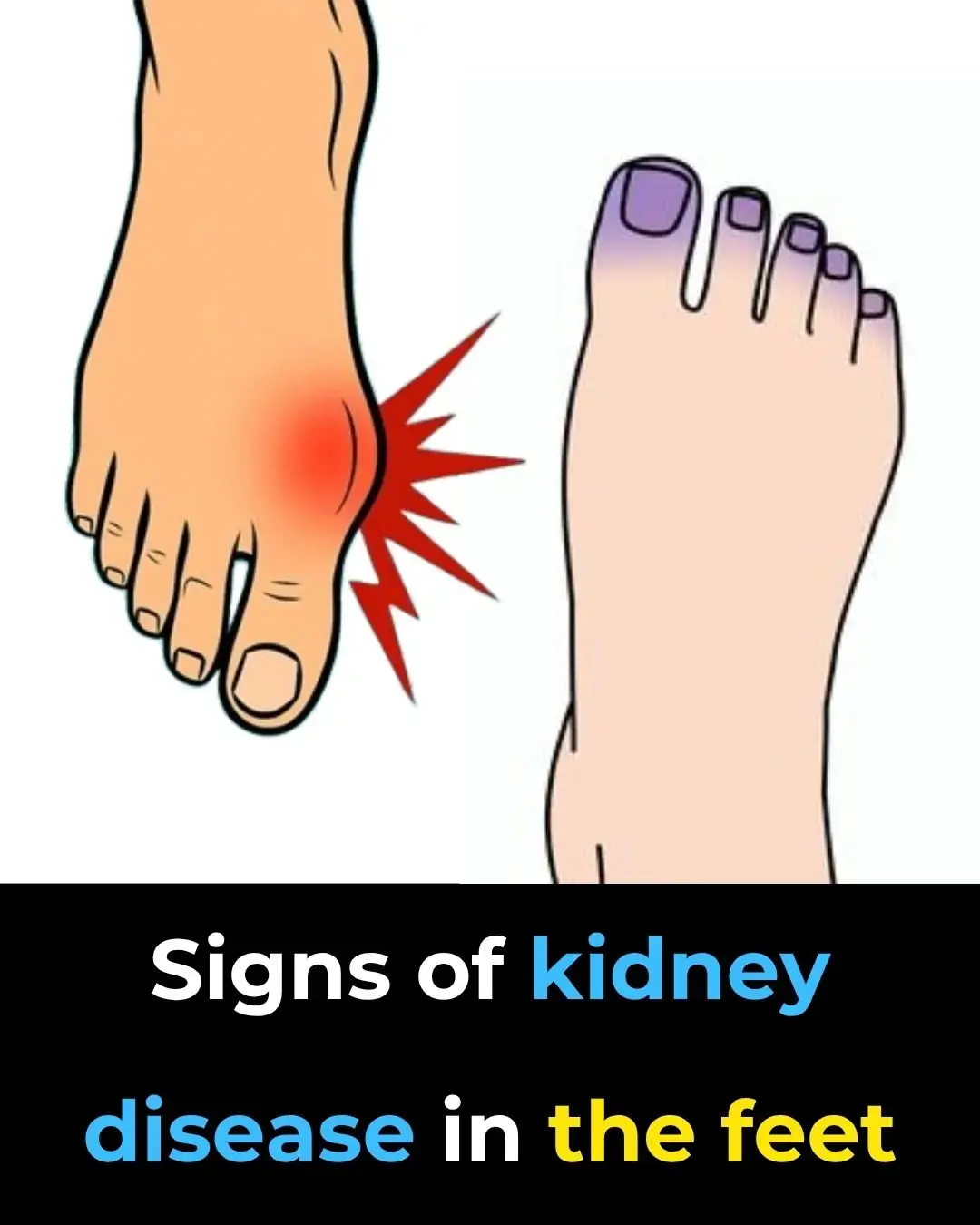 Síntomas en los pies que podrían indicar problemas renales