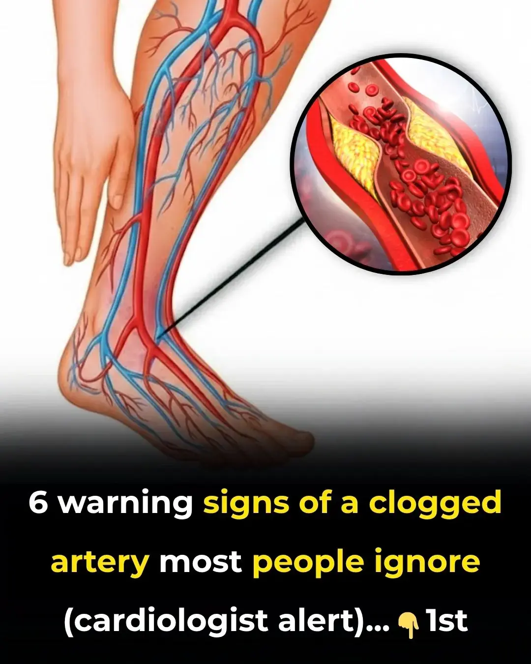 6 señales de advertencia de una arteria obstruida que la mayoría de la gente ignora (alerta del cardiólogo)