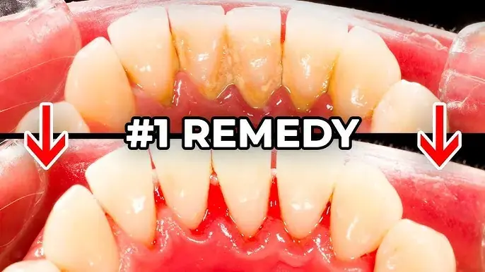 El remedio número uno más eficaz para la placa dental (y cómo vencer el sarro en casa)